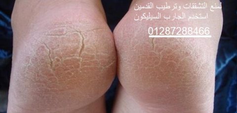 جوارب واقية من جل السيليكون 2